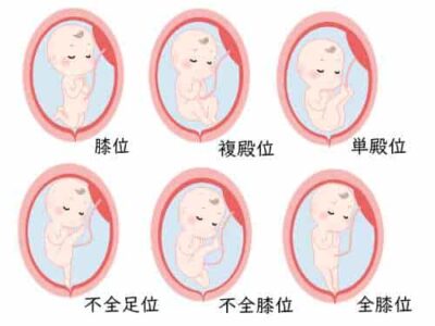 逆子の種類 逆子の種類