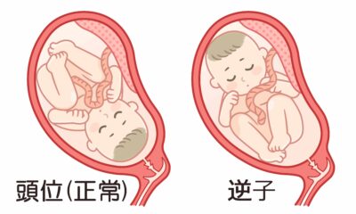 正常な胎児、逆子の胎児 逆子