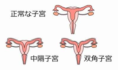 子宮の奇形 子宮の奇形