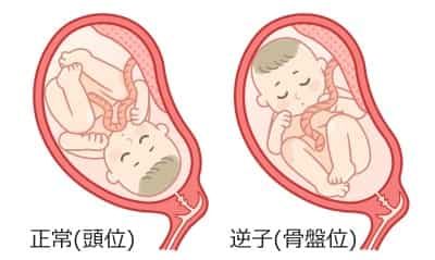 逆子の姿勢 逆子の姿勢