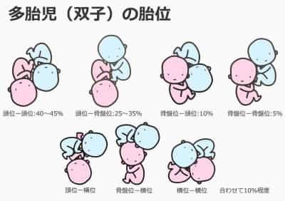 多胎児（双子）の胎位