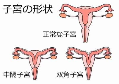 子宮の形状