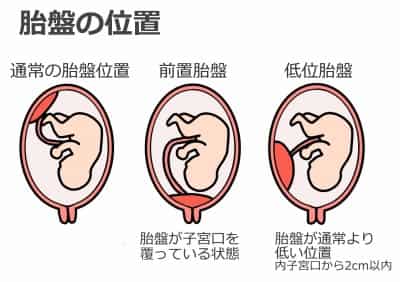 胎盤の位置