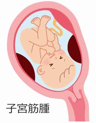 子宮筋腫 子宮筋腫
